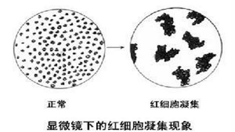 图片正常的红细胞和凝集的红细胞