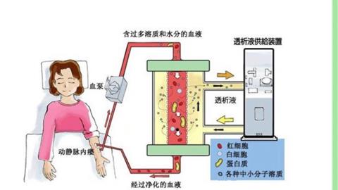 图片血液透析示意图
