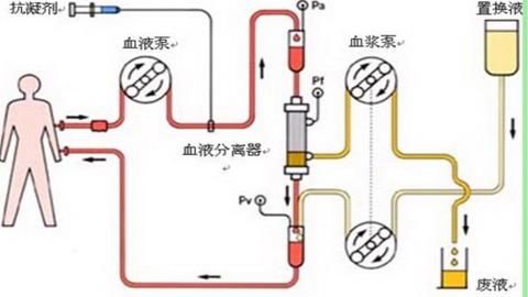 图片血液透析示意图
