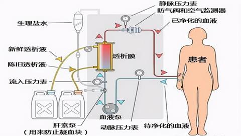 图片肾透析原理示意图
