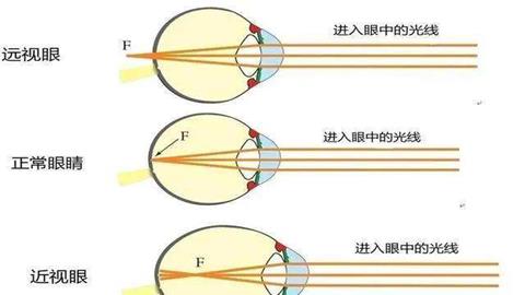图片近视眼佩戴眼镜前后眼球的成像情况对比