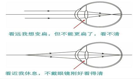 图片近视眼佩戴眼镜前后眼球的成像情况对比
