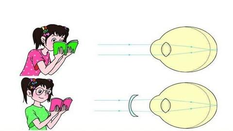 图片近视眼佩戴眼镜前后眼球的成像情况对比