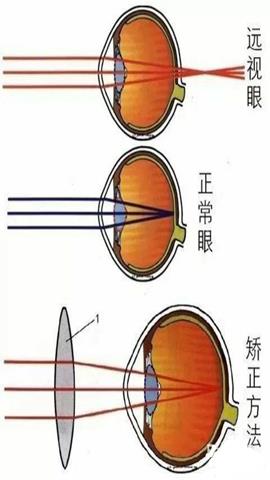 图片正常眼、视眼及近视眼的矫正示意图