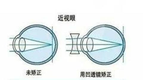 图片近视及其矫正