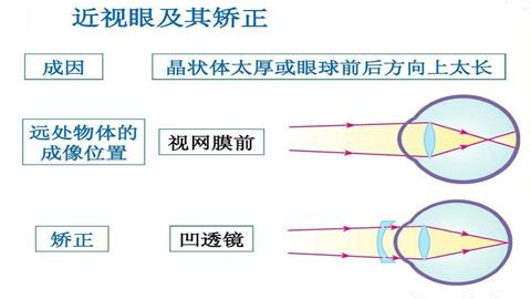 图片近视及其矫正