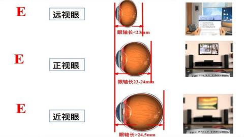 图片近视、远视及正视