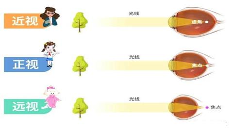 图片近视、远视及正视