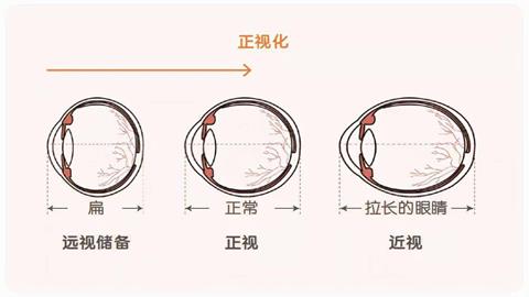 图片近视、远视及正视