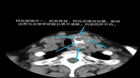 图片甲状腺影像图