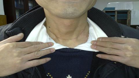 图片甲状腺肿大