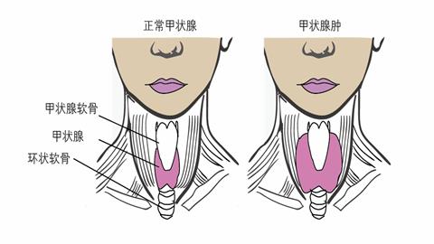图片甲状腺肿大