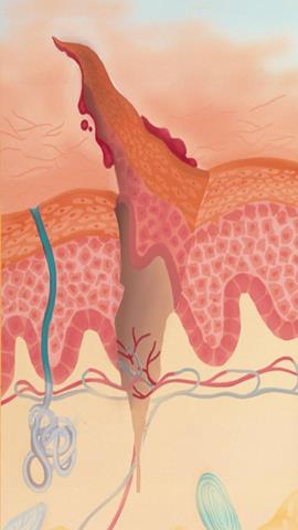 图片毛细血管流血模式图